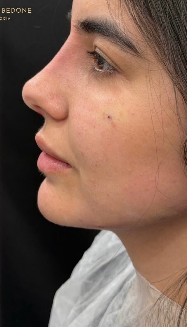 Resultado de perfiloplastia
